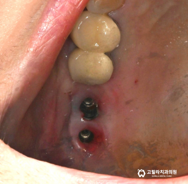 치아가 많이 갈려서 짧아졌어요, 임플란트 재수술 이미지 8