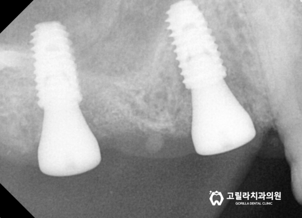 많이 흔들리는 브릿지 , 상악동 거상술을 동반한 임플란트 수술 이미지 14