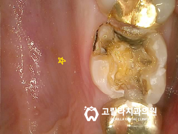 자연치아 살리기, 오래된 보철물의 치료 이미지 12