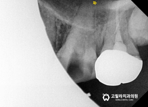 자연치아 살리기 *신경치료* 이미지 10