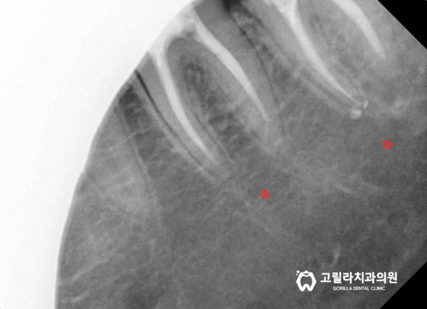 자연치아 살리기 *신경치료* 이미지 14