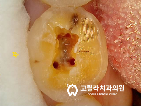 이갈이로 인한 치아파절 임플란트치료 이미지 10