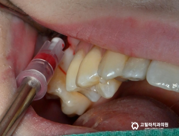 상악동 세척술 & 임플란트 수술 이미지 2