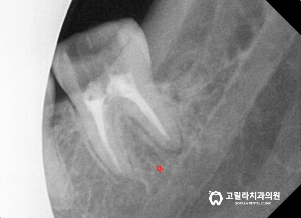 영구치 결손으로 인해 잔존 유치 -> 임플란트 이미지 10