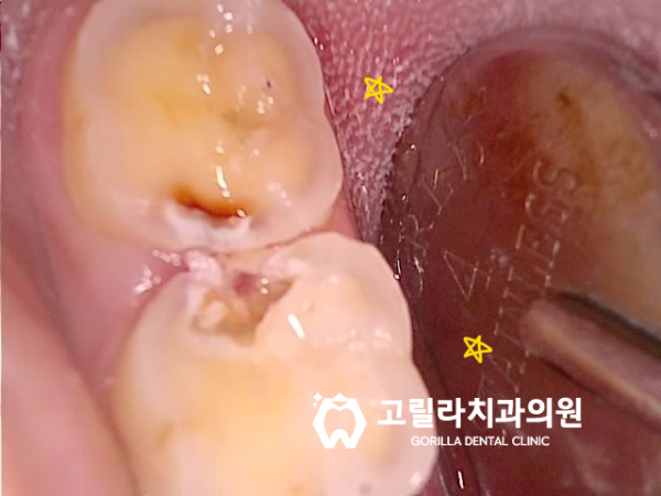 치실중요성 - 신경치료 , 크라운 보철치료 이미지 11