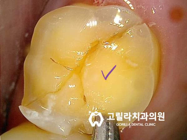 [강한 교합력]으로 인한 크랙치아 임플란트 이미지 14