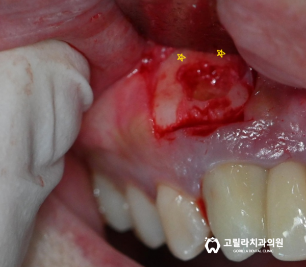 [치근단절제술] 치아를 살리는 마지막 치료 이미지 2