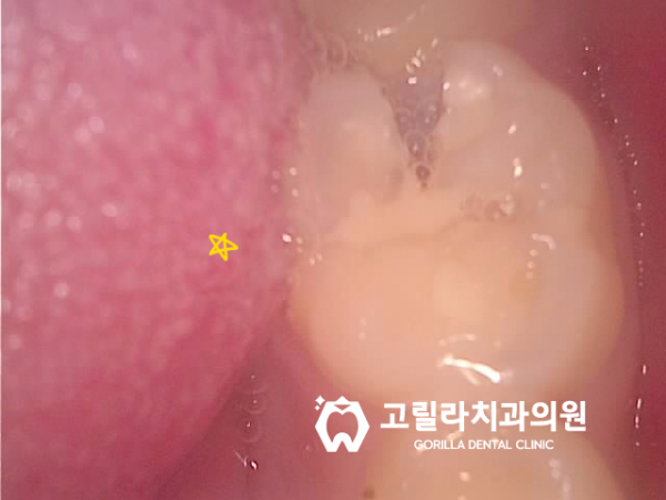 [신경치료] 치과마다 다른 복잡하고 어려운 치료 이미지 10