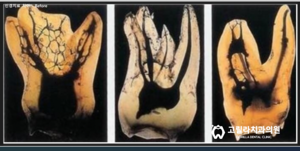 [신경치료] 치과마다 다른 복잡하고 어려운 치료 이미지 4