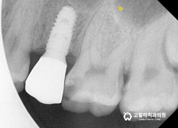 [신경치료] 치과마다 다른 복잡하고 어려운 치료 이미지 9