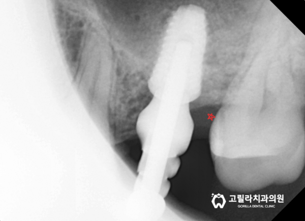 [임플란트 보철의 중요성] 임플란트 흔들려요, 기둥부의 파절 이미지 6