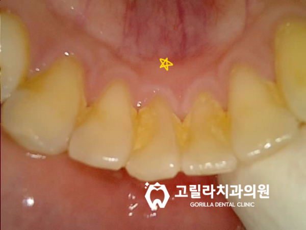 [임플란트 + 상악동 거상술] 통증 적은 수술 이미지 8