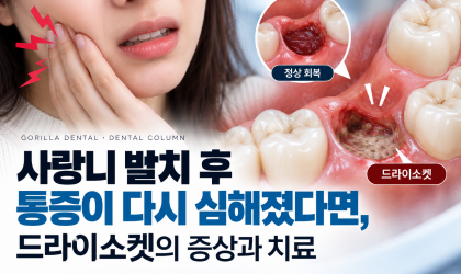 사랑니 발치 후 통증이 다시 심해졌다면, 드라이소켓의 증상과 치료｜용인치과 역북동치과