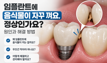 임플란트에 음식물이 낀다면, 컨택과 보철 형태부터 확인하세요｜용인치과 역북동치과