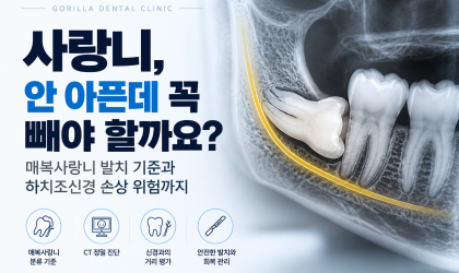 사랑니, 안 아픈데 꼭 빼야 할까요? 매복사랑니 발치 기준과 하치조신경 손상 위험