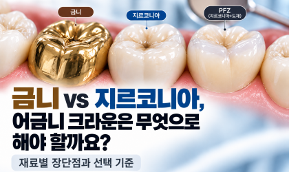 어금니 크라운 재료 비교, 지르코니아·골드·PFM의 차이｜용인치과 역북동치과