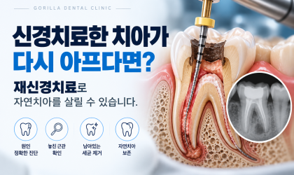 신경치료한 치아가 다시 아프다면? 재신경치료의 원인·과정·성공률