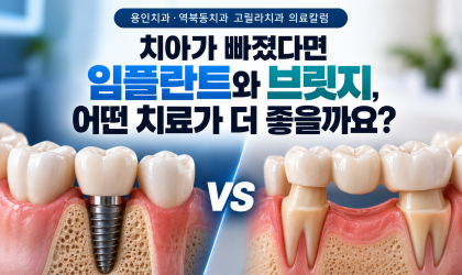 치아가 빠졌다면 임플란트와 브릿지, 어떤 치료가 더 좋을까요?