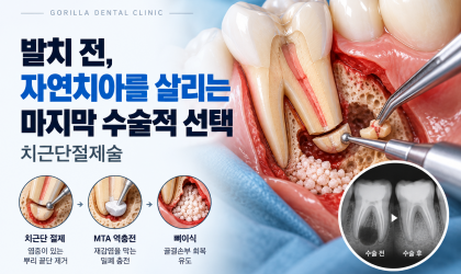 치근단절제술, 발치 전 자연치아를 살리는 마지막 수술적 선택
