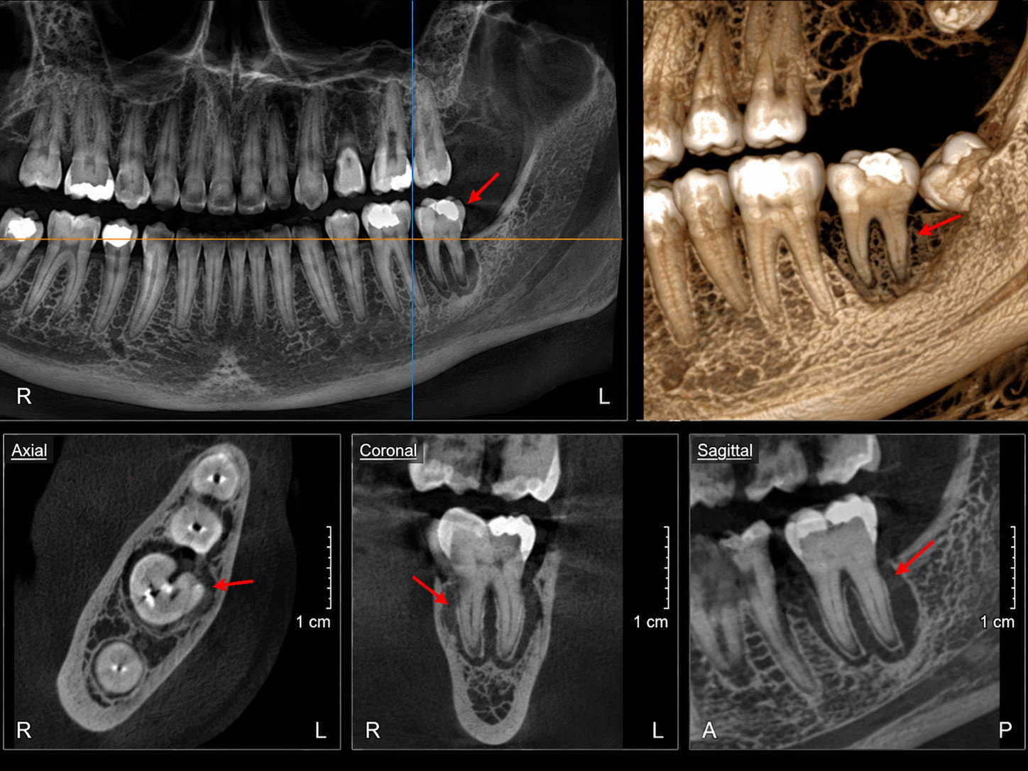 임플란트 진단 3D CT 화면
