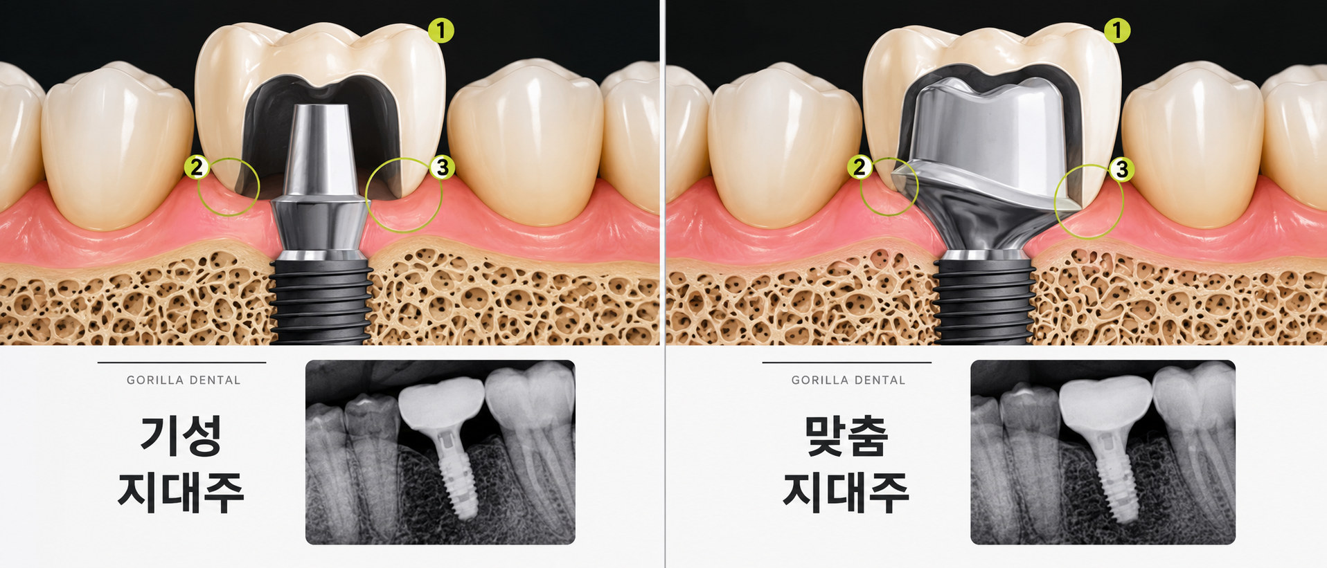 기성 어버트먼트와 커스텀 어버트먼트 비교
