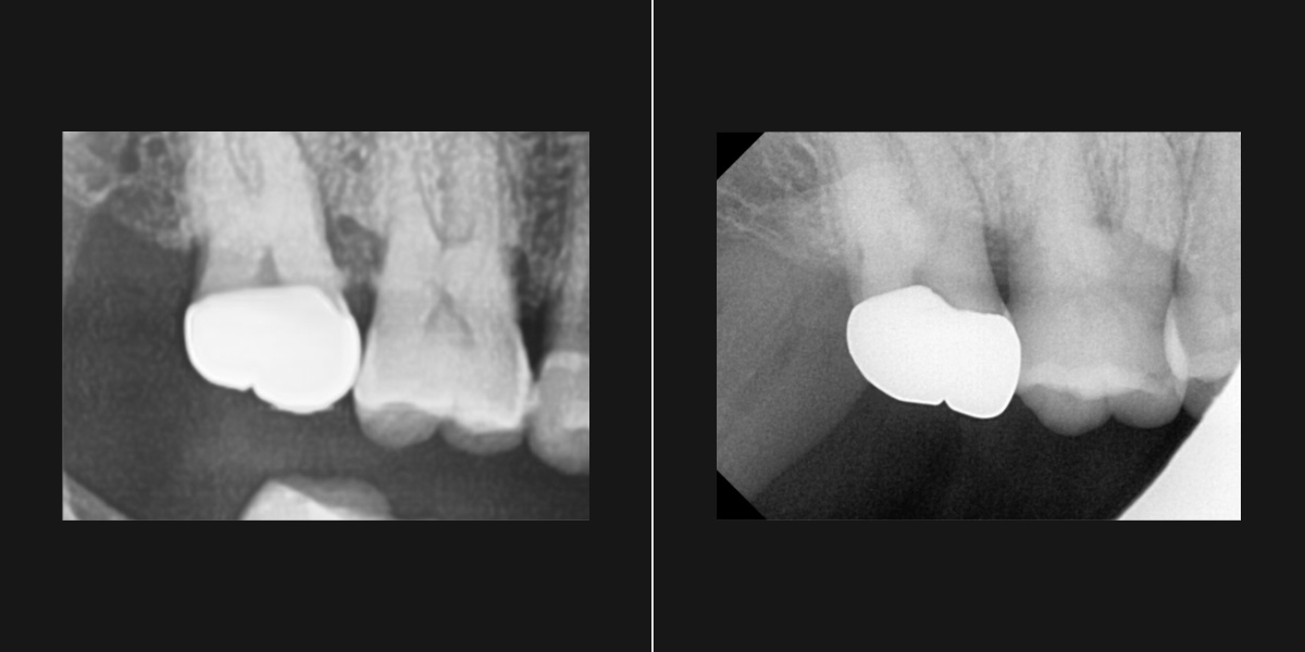 역북동 고릴라치과 잇몸상태 PA X-ray