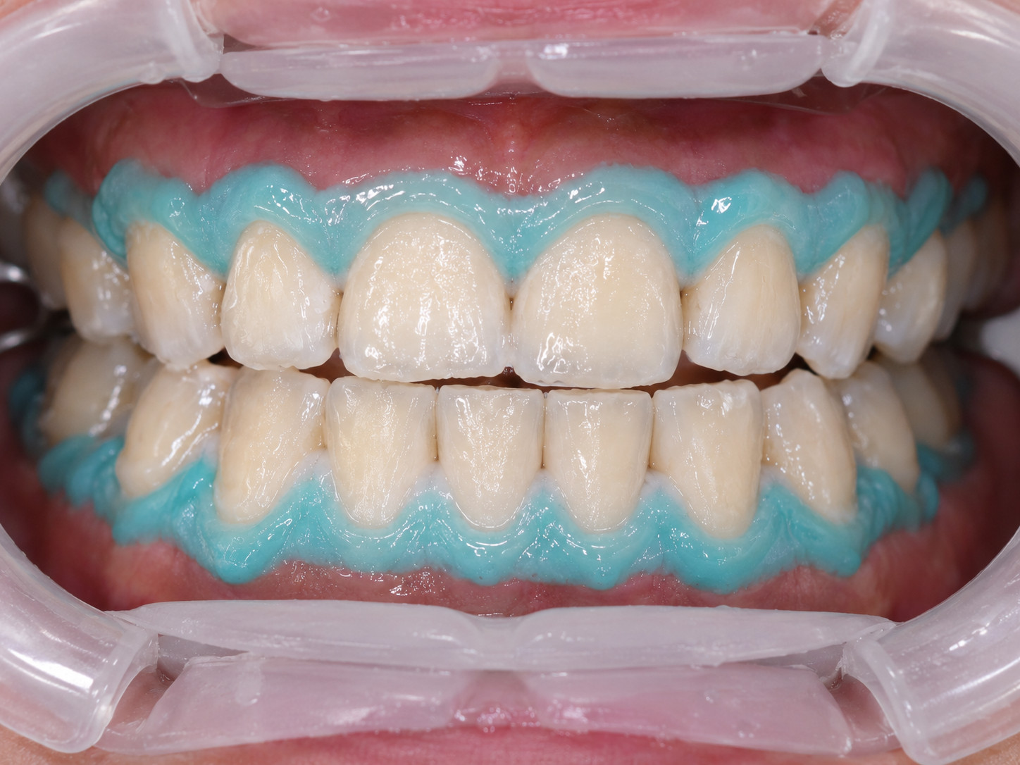치아미백 잇몸보호 Gingival Barrier